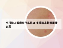 小孩脸上长癣有什么忌口 小孩脸上长癣用什么药