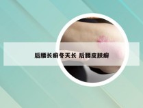 后腰长癣冬天长 后腰皮肤癣