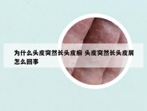 为什么头皮突然长头皮癣 头皮突然长头皮屑怎么回事