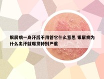 银屑病一身汗后不用管它什么意思 银屑病为什么出汗就爆发特别严重