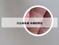 什么叫头癣 头癣的特征