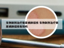 生物制剂治疗银屑病肺结核 生物制剂治疗银屑病肺结核有效吗