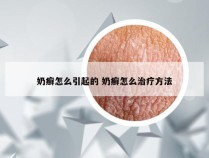 奶癣怎么引起的 奶癣怎么治疗方法