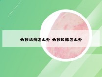 头顶长癣怎么办 头顶长藓怎么办