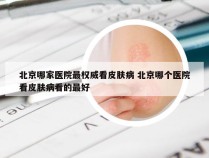 北京哪家医院最权威看皮肤病 北京哪个医院看皮肤病看的最好