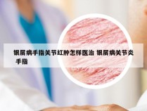 银屑病手指关节红肿怎样医治 银屑病关节炎 手指