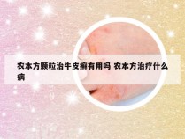 农本方颗粒治牛皮癣有用吗 农本方治疗什么病