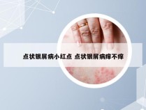 点状银屑病小红点 点状银屑病痒不痒