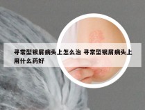 寻常型银屑病头上怎么治 寻常型银屑病头上用什么药好