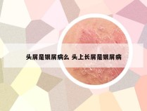 头屑是银屑病么 头上长屑是银屑病