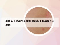 男童头上长癣怎么回事 男孩头上长癣是什么原因