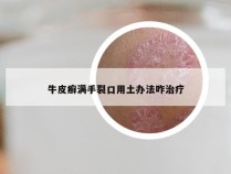 牛皮癣满手裂口用土办法咋治疗