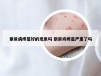 银屑病痒是好的现象吗 银屑病痒是严重了吗