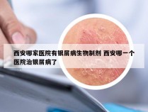 西安哪家医院有银屑病生物制剂 西安哪一个医院治银屑病了