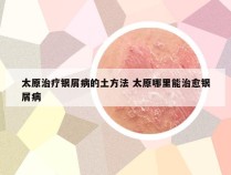 太原治疗银屑病的土方法 太原哪里能治愈银屑病