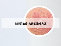 头藓的治疗 头藓的治疗方案