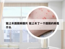 腿上长圆圈癣图片 腿上长了一个圆圈的癣是什么