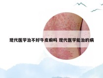 现代医学治不好牛皮癣吗 现代医学能治的病