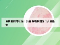 生物制剂可以治什么病 生物制剂治什么病最好