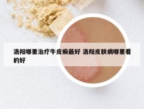 洛阳哪里治疗牛皮癣最好 洛阳皮肤病哪里看的好