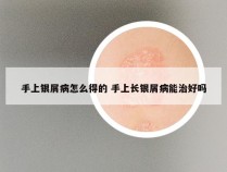 手上银屑病怎么得的 手上长银屑病能治好吗