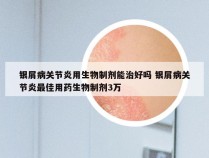 银屑病关节炎用生物制剂能治好吗 银屑病关节炎最佳用药生物制剂3万