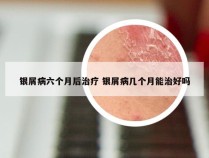 银屑病六个月后治疗 银屑病几个月能治好吗