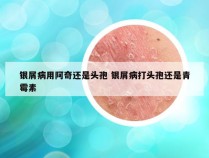 银屑病用阿奇还是头孢 银屑病打头孢还是青霉素