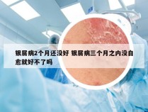 银屑病2个月还没好 银屑病三个月之内没自愈就好不了吗