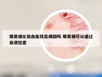 银屑病化验血能找出病因吗 银屑病可以通过血液检查