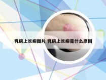 乳房上长癣图片 乳房上长癣是什么原因