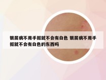 银屑病不用手抠就不会有白色 银屑病不用手抠就不会有白色的东西吗