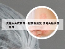 洗完头头皮白白一层皮癣反复 洗完头后头皮一层白