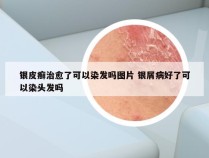 银皮癣治愈了可以染发吗图片 银屑病好了可以染头发吗