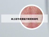 身上出牛皮癣能打新冠疫苗吗