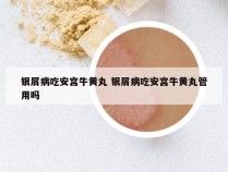 银屑病吃安宫牛黄丸 银屑病吃安宫牛黄丸管用吗