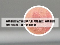 生物制剂治疗皮肤病几针开始有效 生物制剂治疗皮肤病几针开始有效果