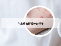 牛皮癣治好后什么样子