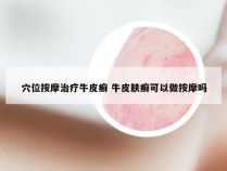 穴位按摩治疗牛皮癣 牛皮肤癣可以做按摩吗