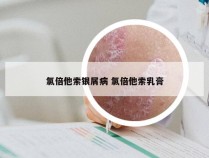 氯倍他索银屑病 氯倍他索乳膏