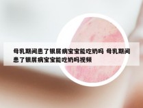 母乳期间患了银屑病宝宝能吃奶吗 母乳期间患了银屑病宝宝能吃奶吗视频