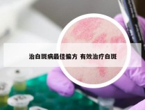 治白斑病最佳偏方 有效治疗白斑