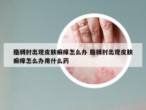 胳膊肘出现皮肤癣痒怎么办 胳膊肘出现皮肤癣痒怎么办用什么药