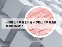 小孩脸上长白癣怎么治 小孩脸上长白癣是什么原因引起的?