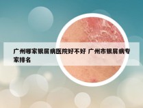 广州哪家银屑病医院好不好 广州市银屑病专家排名