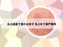 头上起癣了是什么样子 头上长了癣严重吗