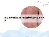 颈后面长癣怎么办 颈后面长癣怎么办用什么药