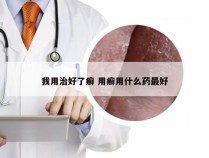 我用治好了癣 用癣用什么药最好