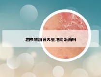 老陈醋加满天星泡能治癣吗