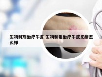 生物制剂治疗牛皮 生物制剂治疗牛皮皮癣怎么样